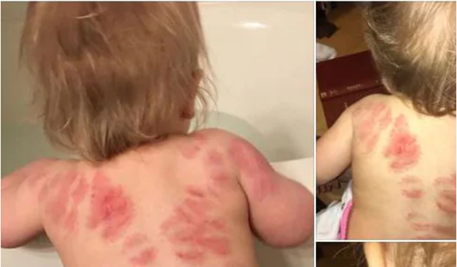 Mum Alyce Bryant was left horrified after discovering her 15-month-old child was covered in ‘bites’ after collecting her from daycare.Source:Facebook