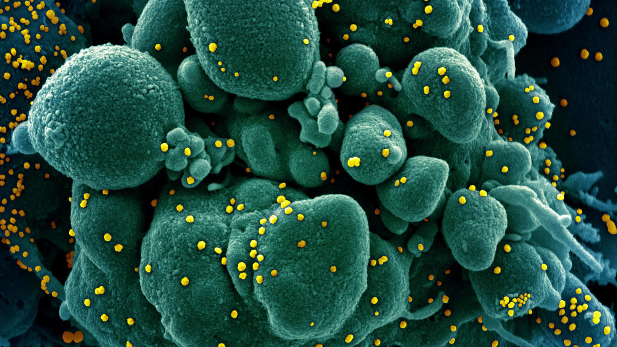 Colourised scanning electron micrograph of an apoptotic cell (green) infected with SARS-COV-2 virus particles (yellow), also known as novel coronavirus, isolated from a patient sample. Image captured at the NIAID Integrated Research Facili