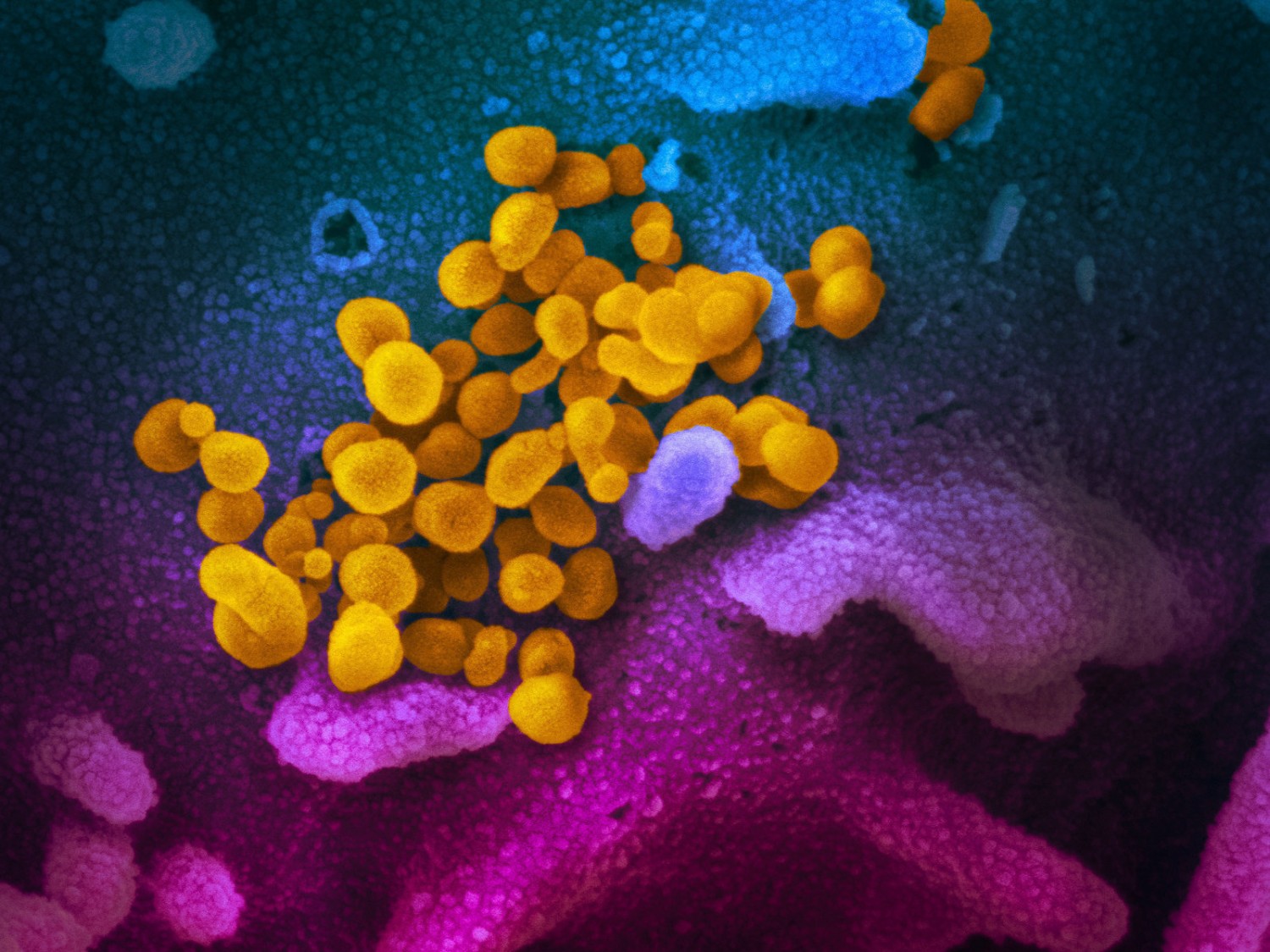 The coronavirus that causes COVID-19 is seen in yellow, emerging from cells (in blue and pink) cultured in the lab. This image is from a scanning electron microscope. NIAID-RML