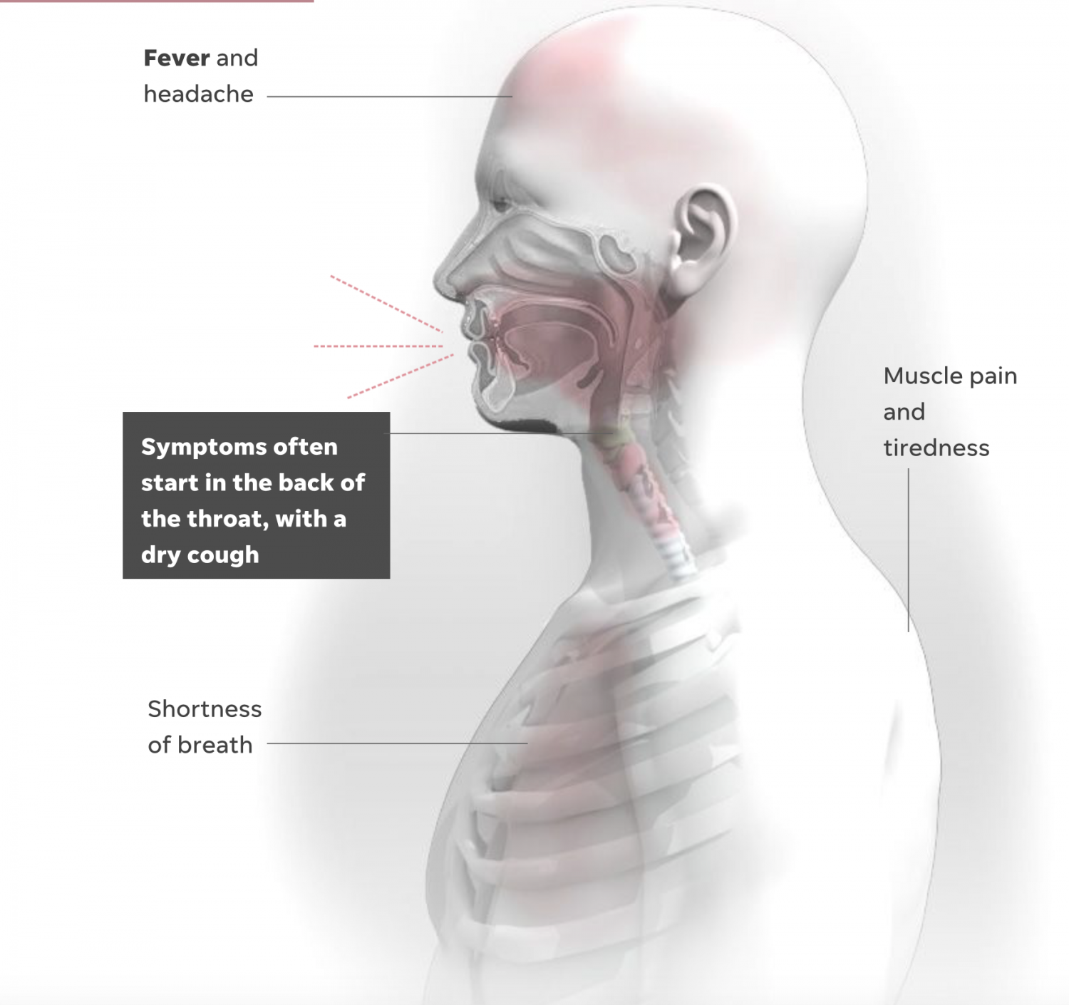 Symptoms often start in the back of the throat, with a dry cough